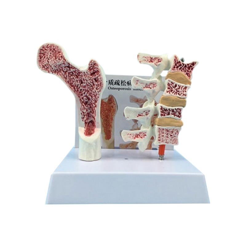 Osteoporosis Spine Model Human Anatomy Osteoporosis Model Medicals Learning Tool for Anatomy Education Constructed 1
Osteoporosis Spine Model Human Anatomy Osteoporosis Model Medicals Learning Tool for Anatomy Education Constructed 1