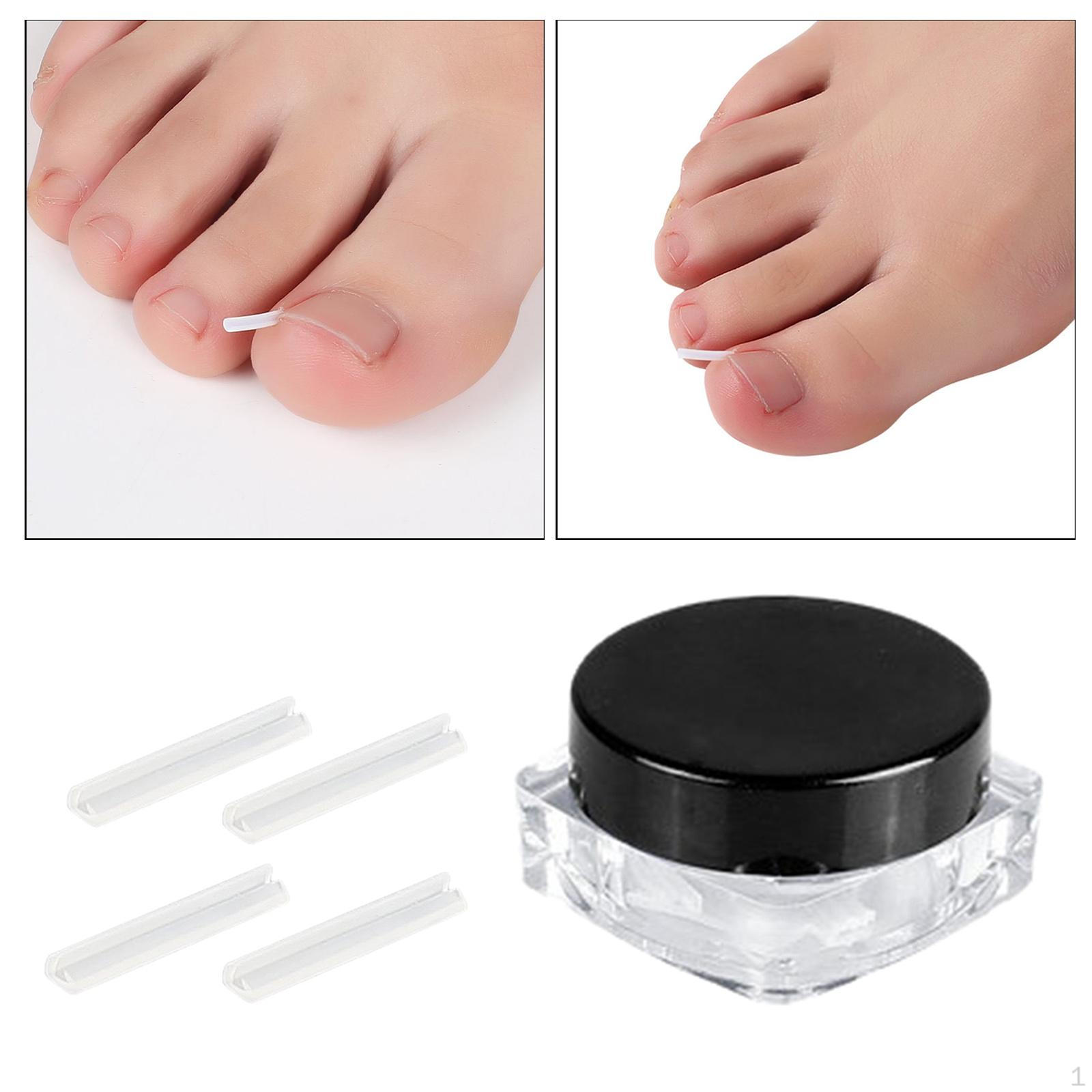 Ingrown Toenail Correction Tool Foot Toe Treatment Corrector Tools Nail ingrown filler 30 Pieces
Ingrown Toenail Correction Tool Foot Toe Treatment Corrector Tools Nail ingrown filler 30 Pieces