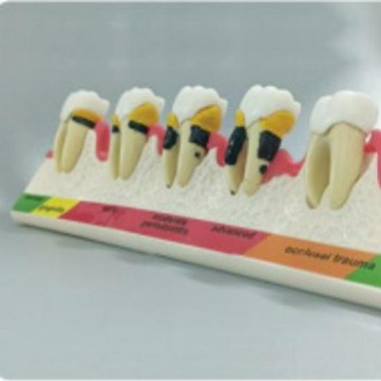 PH4010 Periodontal Classification Model: Dental Mold for Subgingival Calculus Scaling
PH4010 Periodontal Classification Model: Dental Mold for Subgingival Calculus Scaling