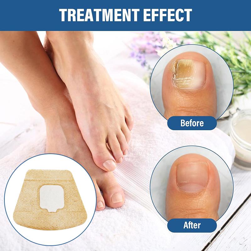 Hydrogel Nail Treatment Patch Anti Fungal Nail Correction Stickers Ingrown Toenail Care Paronychia Anti Infection Repair Patch 2pcs
Hydrogel Nail Treatment Patch Anti Fungal Nail Correction Stickers Ingrown Toenail Care Paronychia Anti Infection Repair Patch 2pcs