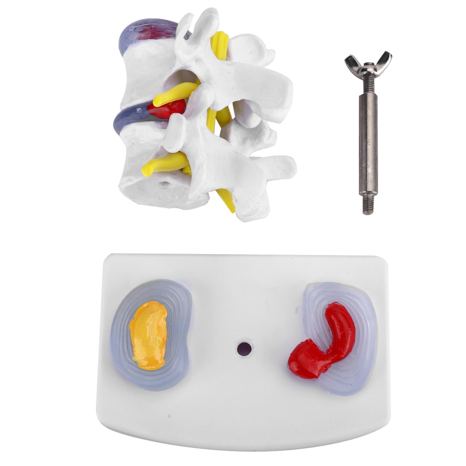Anatomical Lumbar Disc Herniation Demonstration Model Human Spine School Training Supplies 
Anatomical Lumbar Disc Herniation Demonstration Model Human Spine School Training Supplies