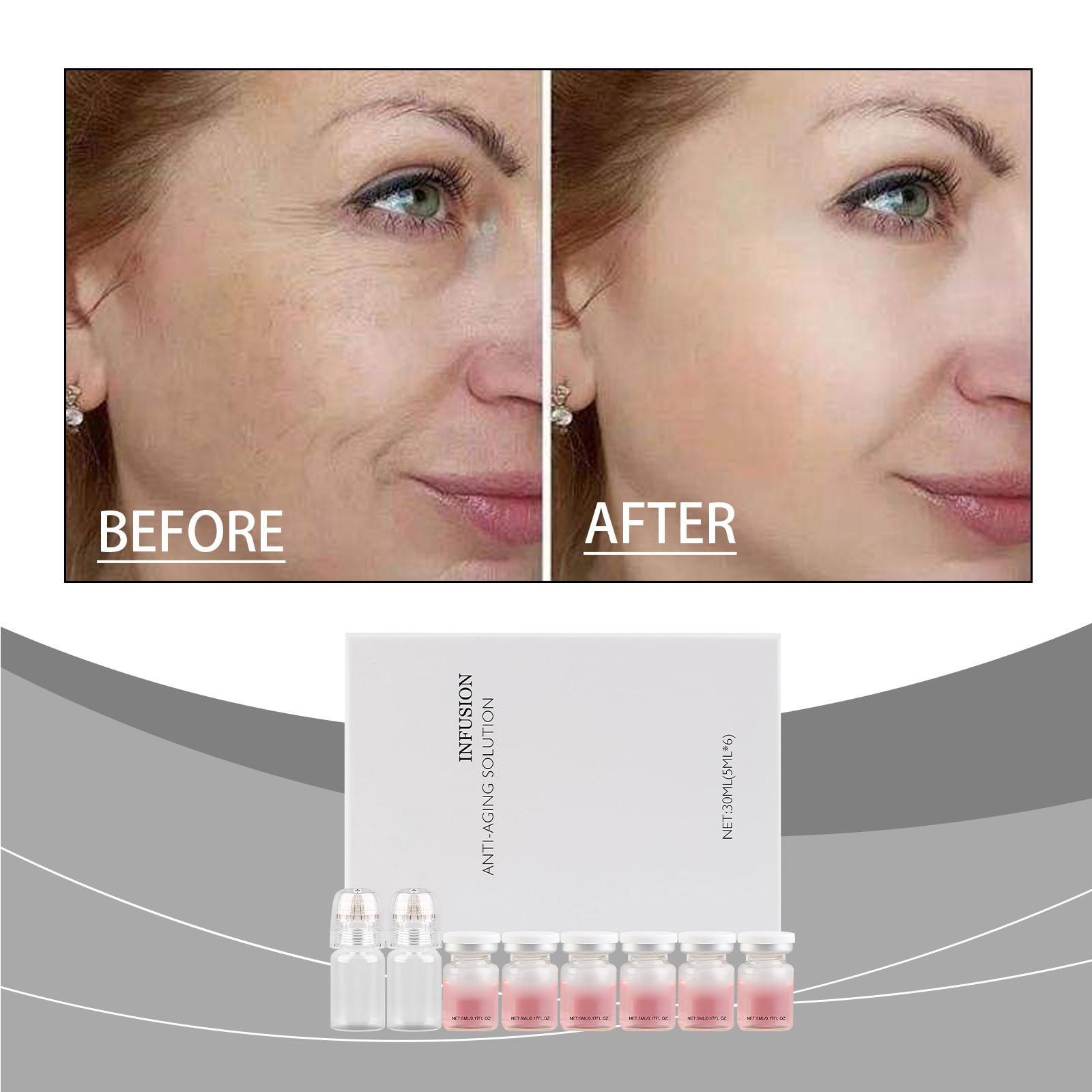 Moisturizing Firming Roller Microneedle Kit Anti-aging Wrinkle Smoothing Facial Serum Facial Micro-injection 30ML
Moisturizing Firming Roller Microneedle Kit Anti-aging Wrinkle Smoothing Facial Serum Facial Micro-injection 30ML