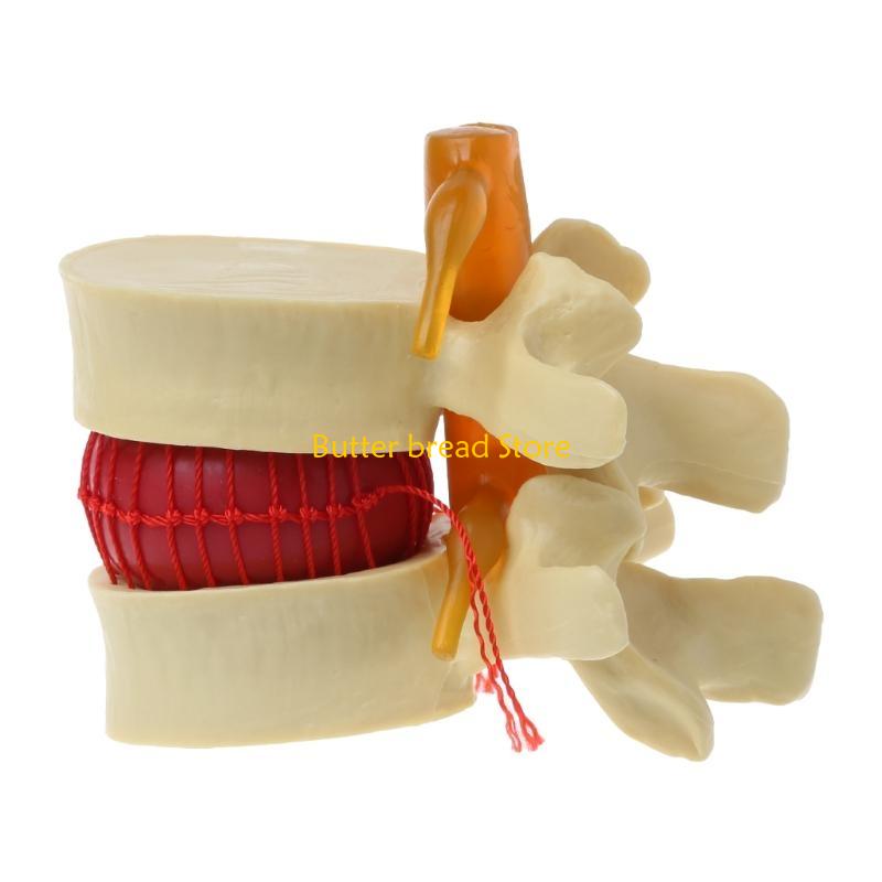 W89C Human Anatomy Skeleton Spine Lumbar Disc Herniation Teaching Model Spinal Lesions Medical Teaching Tool Props белый
W89C Human Anatomy Skeleton Spine Lumbar Disc Herniation Teaching Model Spinal Lesions Medical Teaching Tool Props белый