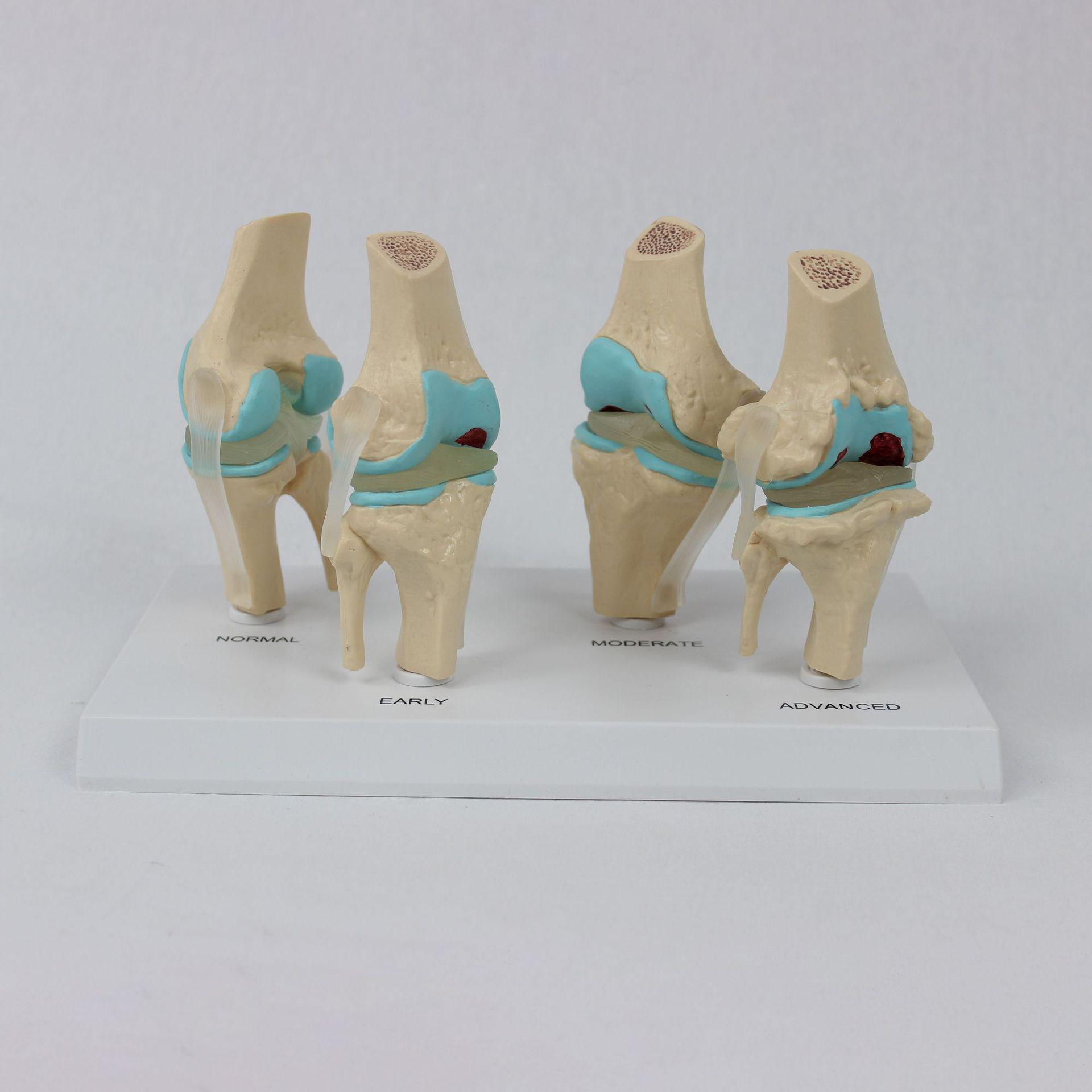 4-Stage Human Knee Evolution Model for Teaching and Display 27.5*16.5*7 cm
4-Stage Human Knee Evolution Model for Teaching and Display 27.5*16.5*7 cm