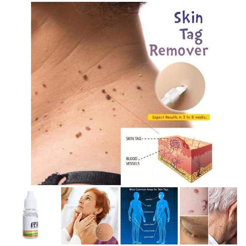 Убить тег бородавка Remover удалить кожи моль & ту тег половых Remover кожи медицинской маскарад
Убить тег бородавка Remover удалить кожи моль & ту тег половых Remover кожи медицинской маскарад
