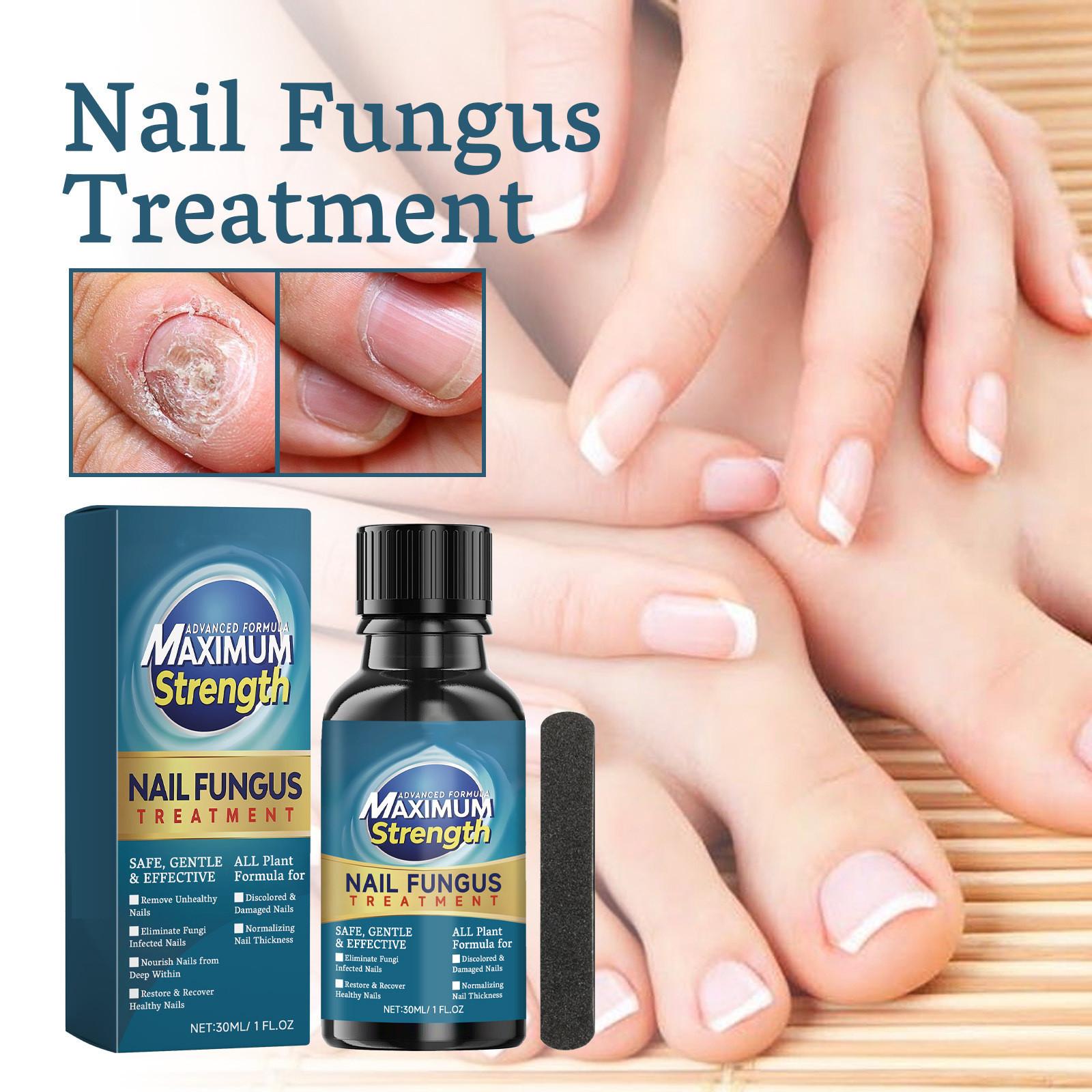 Toenail Fungus Care, быстродействующая жидкость для ухода за ногтями от грибка под и вокруг, восстанавливает здоровый вид ногтей 30 мл
Toenail Fungus Care, быстродействующая жидкость для ухода за ногтями от грибка под и вокруг, восстанавливает здоровый вид ногтей 30 мл