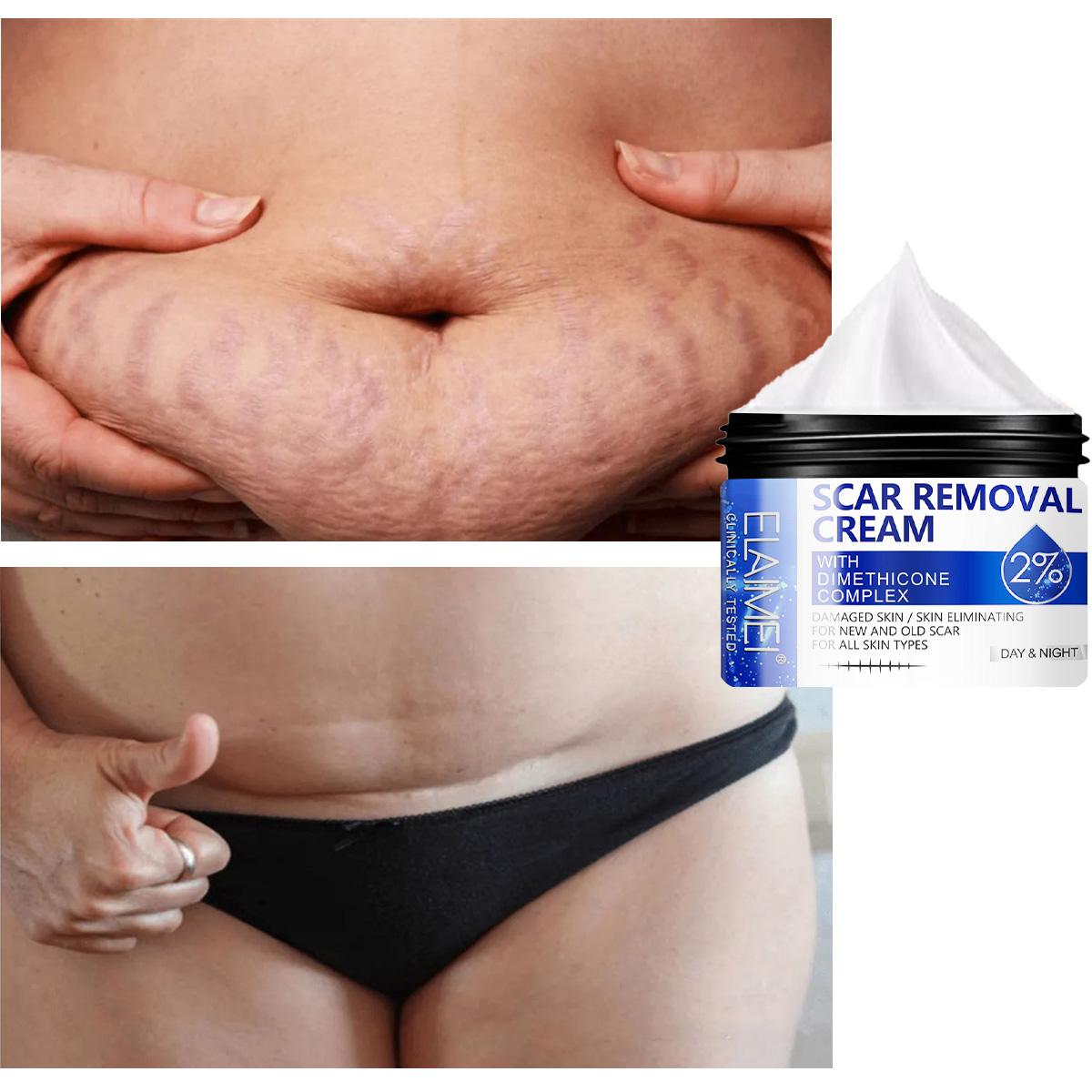 Суперсовременный комплексный крем-эссенция для удаления шрамов. Уход за кожей тела. Восстановление шрамов, ожогов от прыщей.