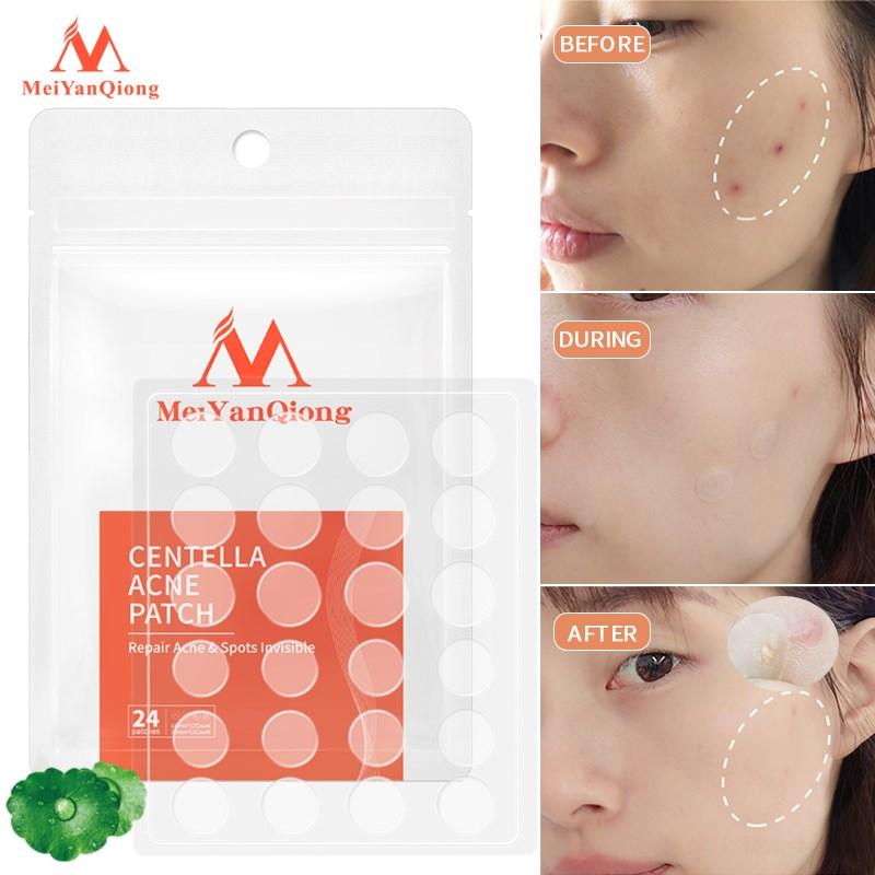 MeiYanQiong Centella патчи от прыщей, наклейки для лечения прыщей, инструмент для удаления пятен, маска для лица, уход за кожей, водонепроницаемые 24 пластыря
MeiYanQiong Centella патчи от прыщей, наклейки для лечения прыщей, инструмент для удаления пятен, маска для лица, уход за кожей, водонепроницаемые 24 пластыря