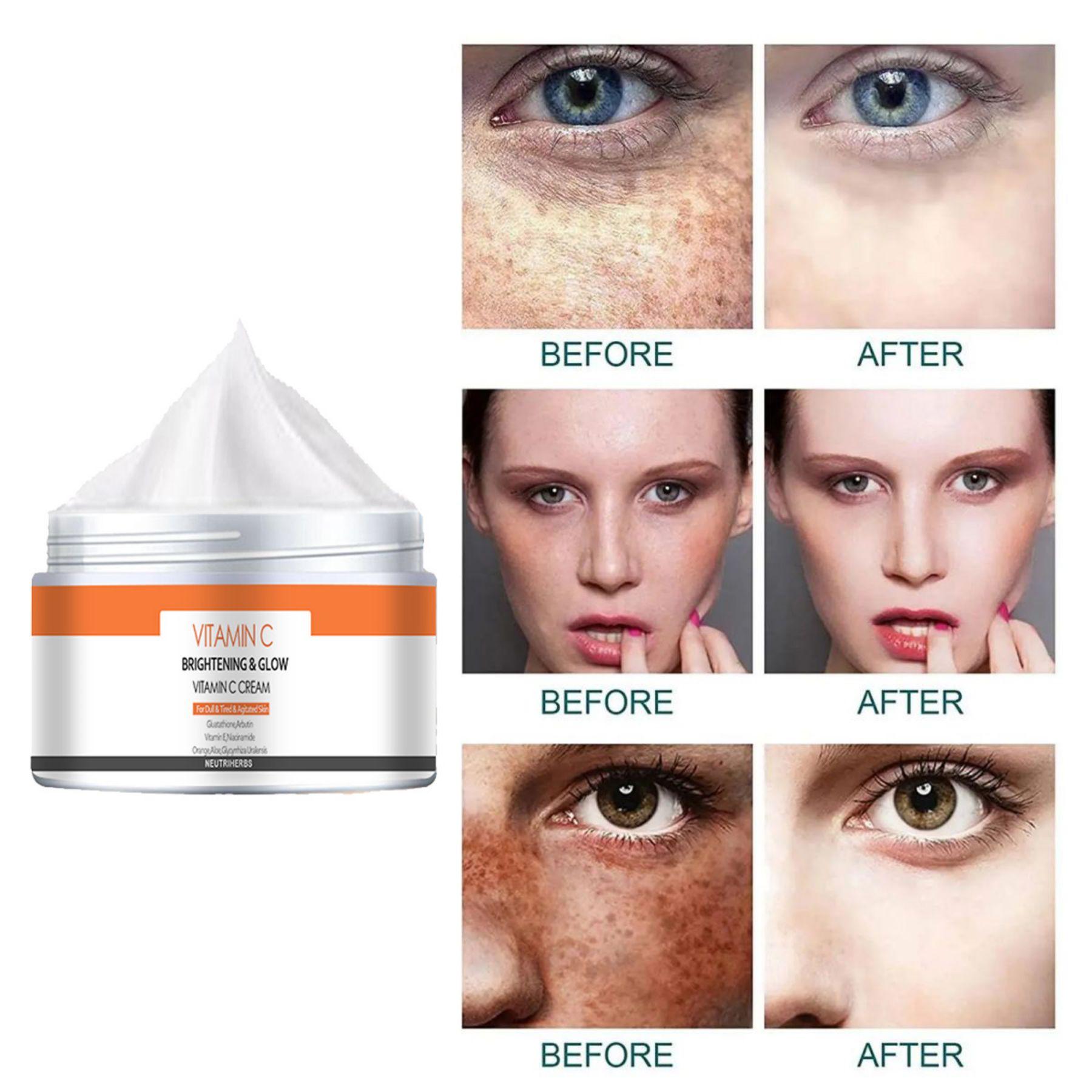 Крем для лица, удаляет хлоазму, прыщи, пигмент, черные точки, средство для ухода за кожей с пигментацией
Крем для лица, удаляет хлоазму, прыщи, пигмент, черные точки, средство для ухода за кожей с пигментацией