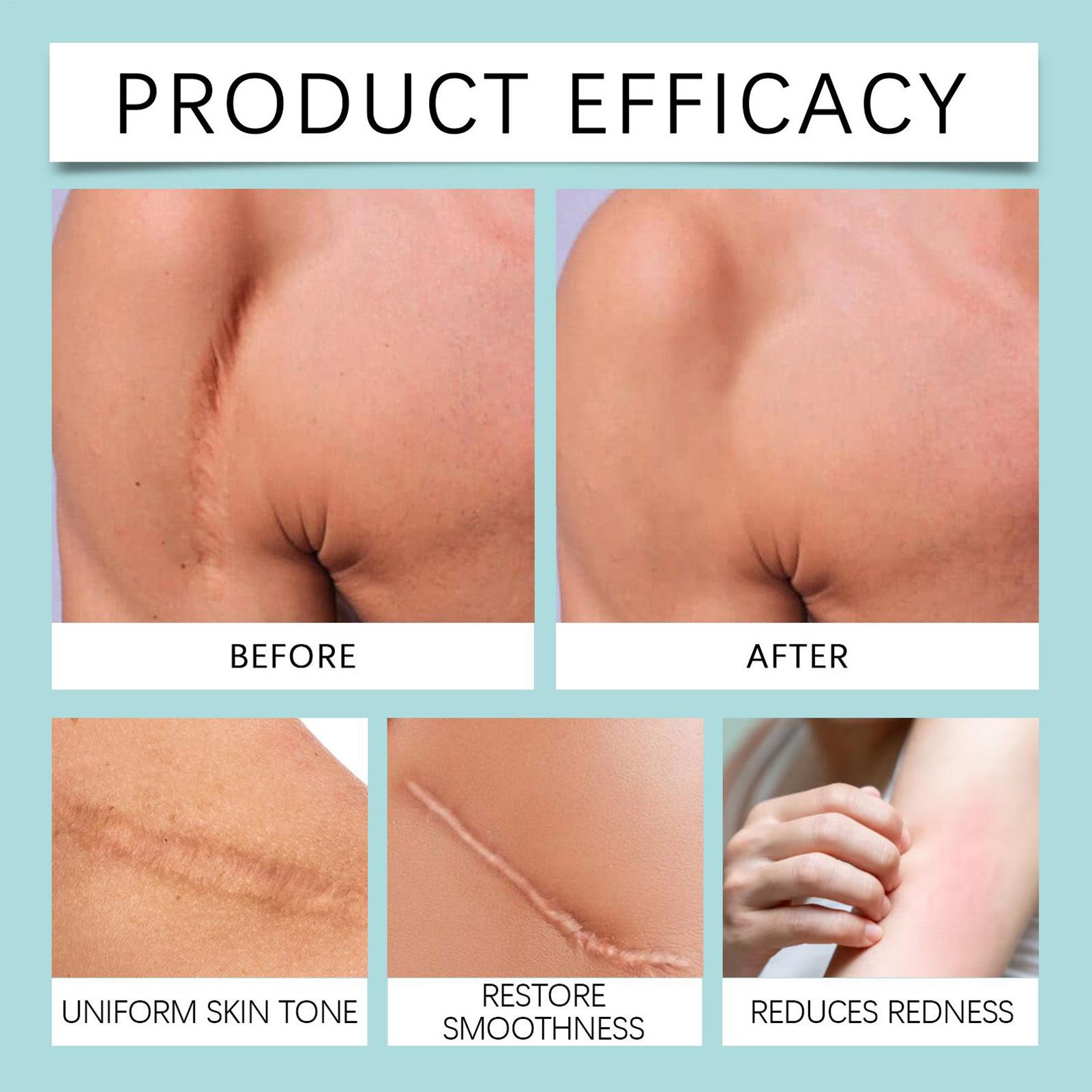 Silicone Scar Tape Cuts Bandage Care Tapes Cuts Bandage Patch For Face Hand Feet Legs Toes Tummy Athletes Women Men Teenagers China Mainland
Silicone Scar Tape Cuts Bandage Care Tapes Cuts Bandage Patch For Face Hand Feet Legs Toes Tummy Athletes Women Men Teenagers China Mainland