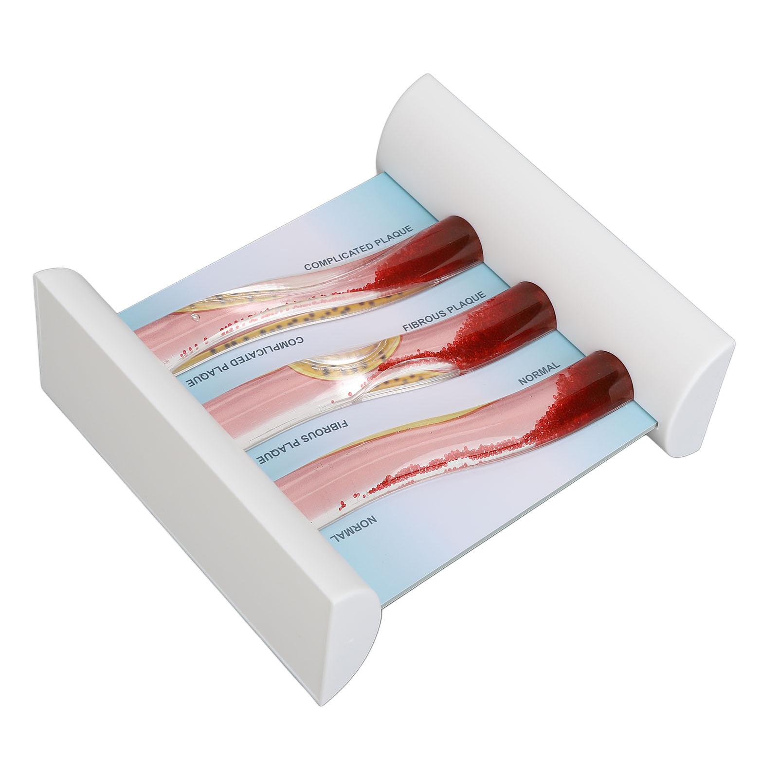 Липопротеин ЛПНП Модель кровеносных сосудов Модель обструкции сосудов с низкой плотностью липидов крови для образования
Липопротеин ЛПНП Модель кровеносных сосудов Модель обструкции сосудов с низкой плотностью липидов крови для образования