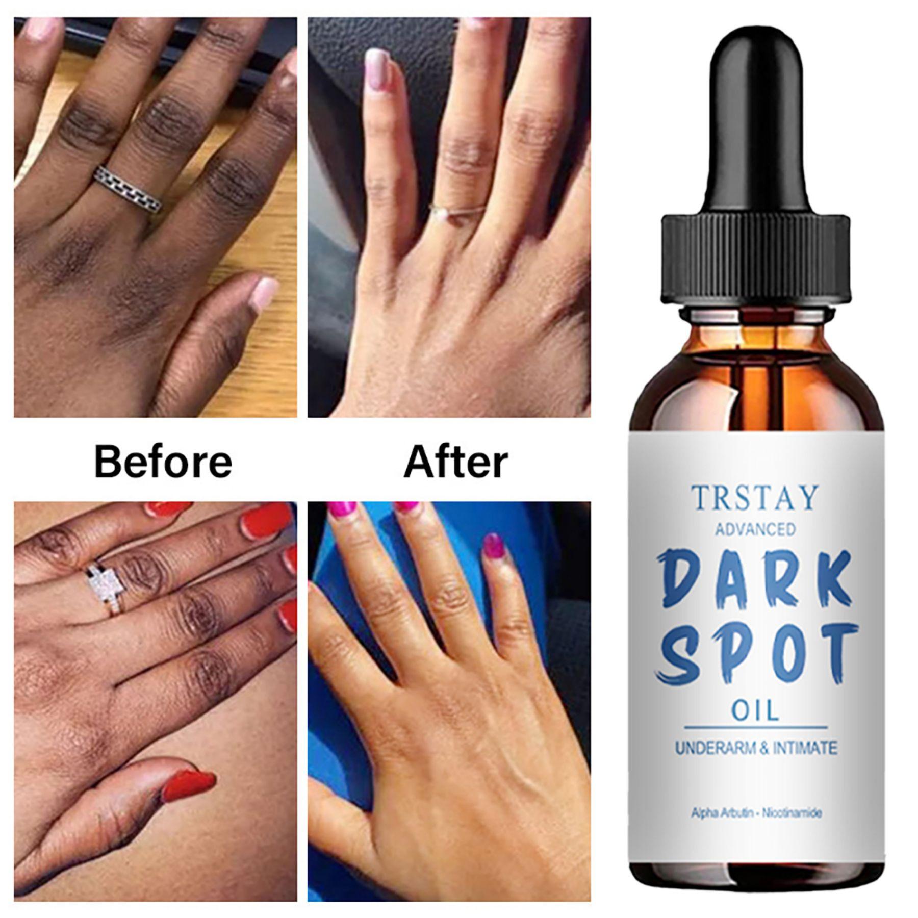 Профессиональное увлажняющее, отбеливающее и удаляющее темные пятна масло для тела