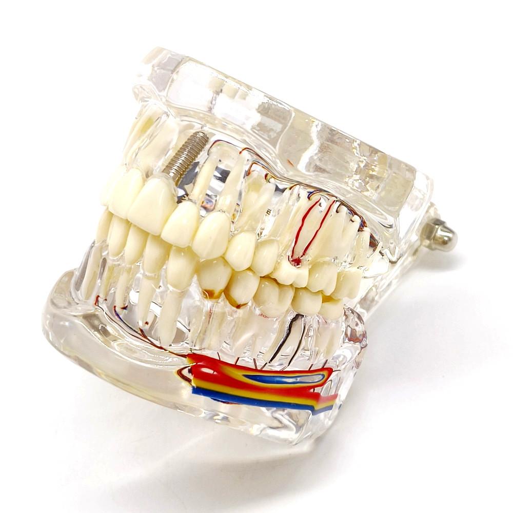 1 шт., модель зубного имплантата с нервом, патологическая модель зубного имплантата, студенты-стоматологи, коммуникационное обучение, исследования, обучение заболеваниям полости рта 1 piece
1 шт., модель зубного имплантата с нервом, патологическая модель зубного имплантата, студенты-стоматологи, коммуникационное обучение, исследования, обучение заболеваниям полости рта 1 piece