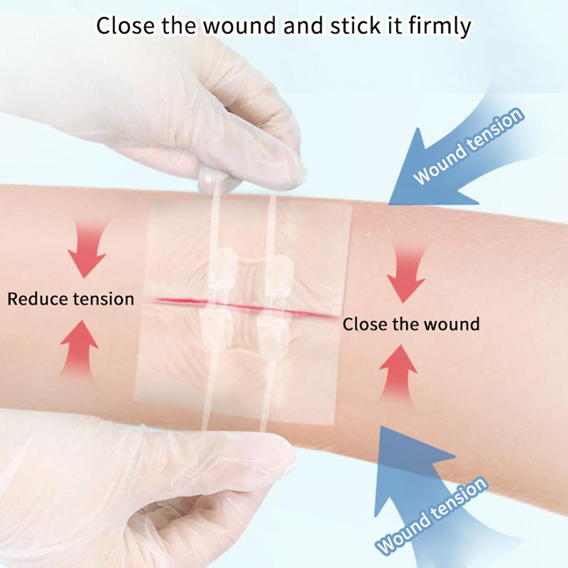 2Pcs/Box Zipper Tie Wound Closure Patch Elastic Strap Fast Suture Hemostatic Patch Skin Care Disinfect Band-Aid Outdoor Portable
2Pcs/Box Zipper Tie Wound Closure Patch Elastic Strap Fast Suture Hemostatic Patch Skin Care Disinfect Band-Aid Outdoor Portable