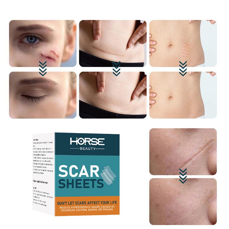 Professional Silicone Gel Scar Sheet Patch Treatment Removal Tape Acne Trauma Burn Scar Cover Skin Repair Section Ear Beauty
Professional Silicone Gel Scar Sheet Patch Treatment Removal Tape Acne Trauma Burn Scar Cover Skin Repair Section Ear Beauty