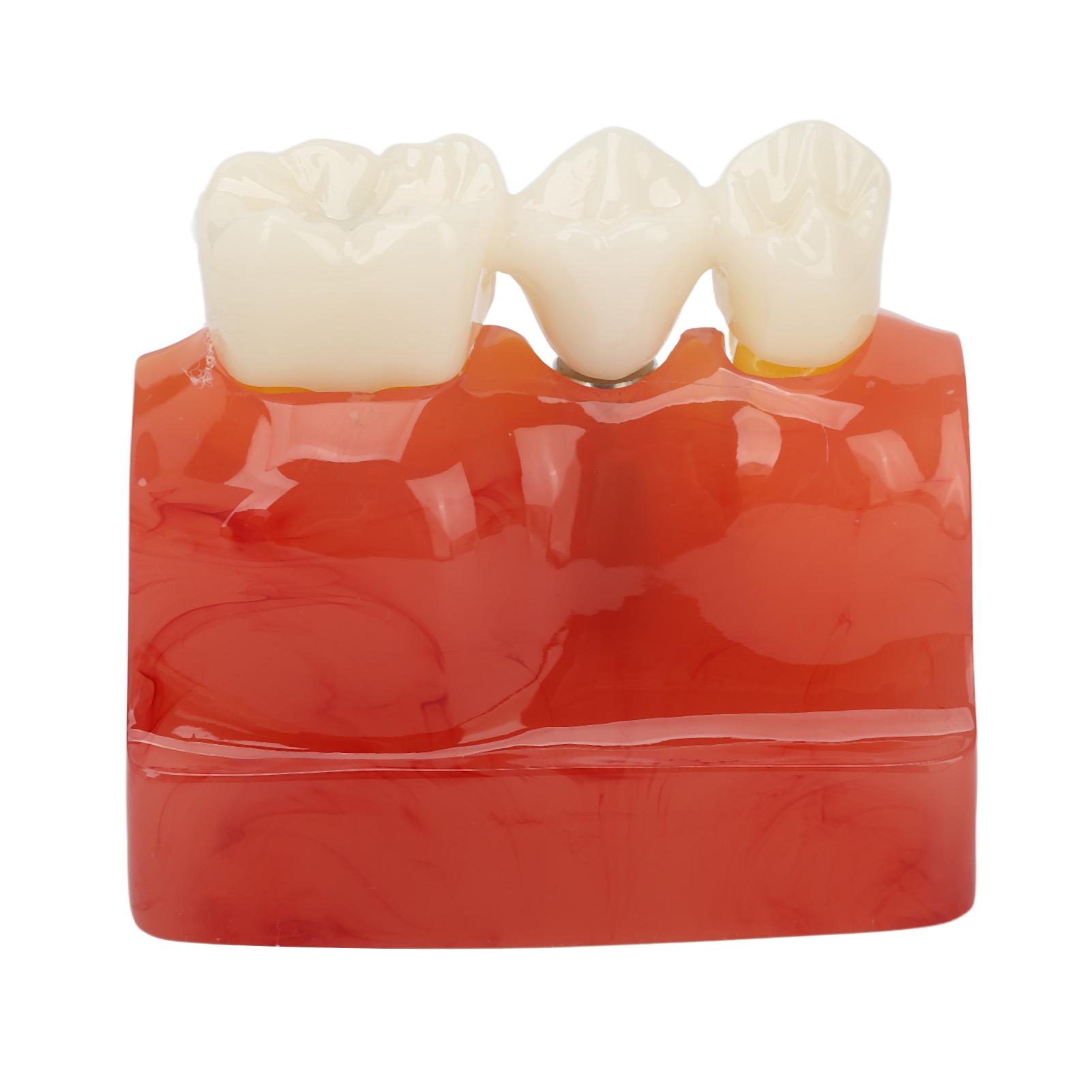 4 Times Dental Implant Model Crown Bridge Implant Teeth Demonstration Model for Doctors Patient Education
4 Times Dental Implant Model Crown Bridge Implant Teeth Demonstration Model for Doctors Patient Education