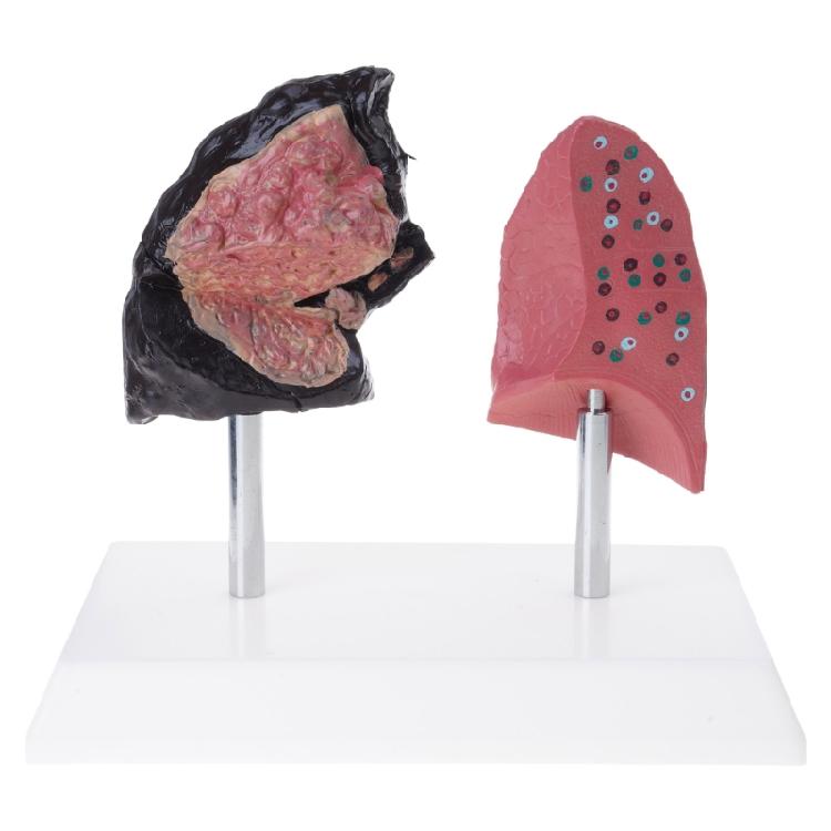 Anatomically Accurate Smoker Lung Comparison Model With Healthy Lung PVC Substance For Clinical Education 1
Anatomically Accurate Smoker Lung Comparison Model With Healthy Lung PVC Substance For Clinical Education 1