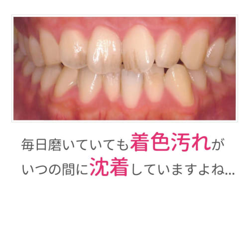 Dental White Proism Polyrin Bubble: Set of 4: Toothpaste Gel [Teeth Whitening at Home, Toothpaste Whitening]