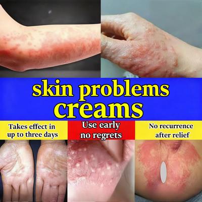 Gentle Dermatitis Relief Cream - Herbal Formula Calms Itching Safe for Sensitive Skin