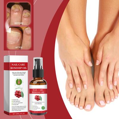Tratamento de unhas para unhas dos pés e dedos Anti-fungos para unhas danificadas.30ml