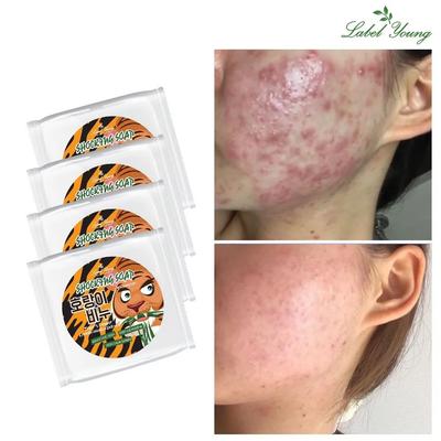 Trattamenti viso – Rimedi contro l'acne