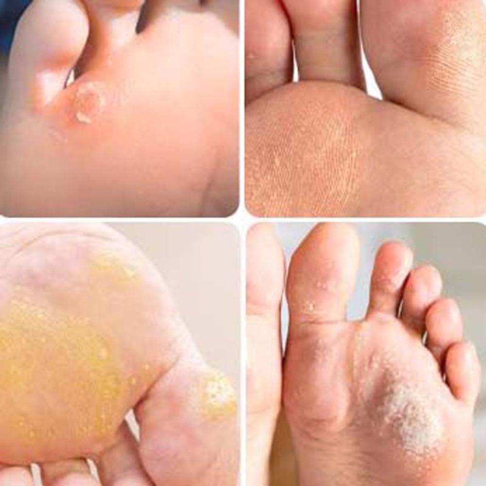 Prevent Calluses Blisters Chicken Eye Patch Foot Cushion Supports Foot Corn Bunion Pads Travel