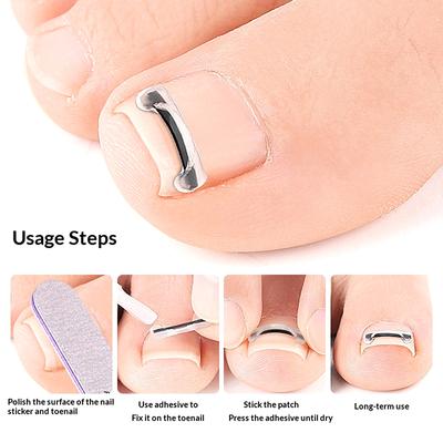 2 Pezzi Strumento Correttivo per Unghie Incarnite Trattamenti per Unghie Incarnite Patch Elastica Adesivo Raddrizzamento Unghie Piede Strumenti per Pedicure