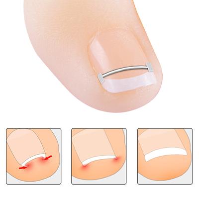 Ingrown Toenail Corrector Tools Pedicure Recover Embed Toe Nail Treatment Professional Ingrown Toenail Correction Foot Care Tool