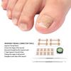 Ingrown Toenail Treatment Kit Toenail Correction Patch C Type Strips Nail File Lifter Pedicure Tool Kits