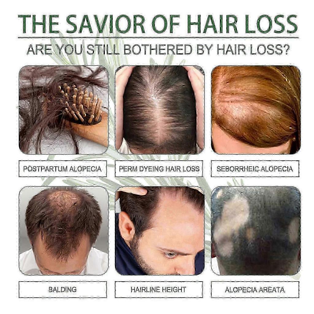 OUHOE rosemary hair thickening essential oil, prevents hair breakage and hair loss, strengthens and nourishes hair roots, and provides dense hair New 