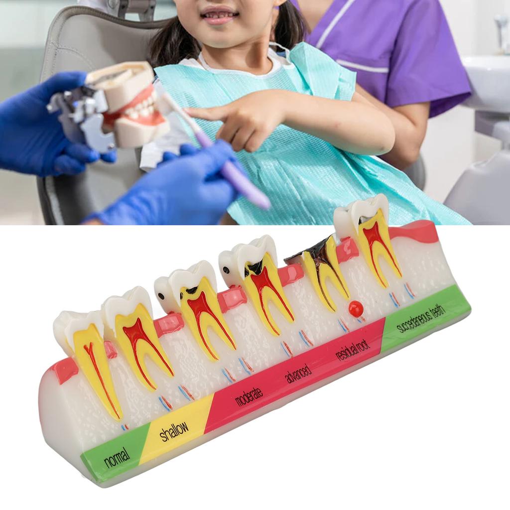 Dental Caries Model 6 Different Stages Resin Decayed Tooth Display Model
