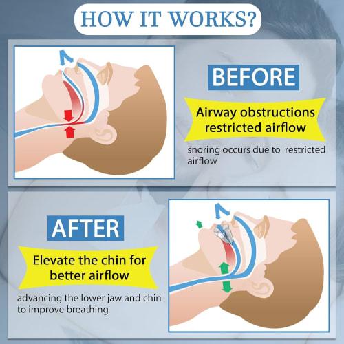 Anti-snoring Mouthpiece, Teeth Grinding Improvement, Adjustable Sleep Aid, Customizable Night Mouthguard, Snoring Aid, Snoring Reduction, Sleep Qualit