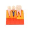 Dental 4 Times Implant Teeth Model Analysis Crown Bridge Demonstration Removable Model Dentistry Study Training Teaching Model