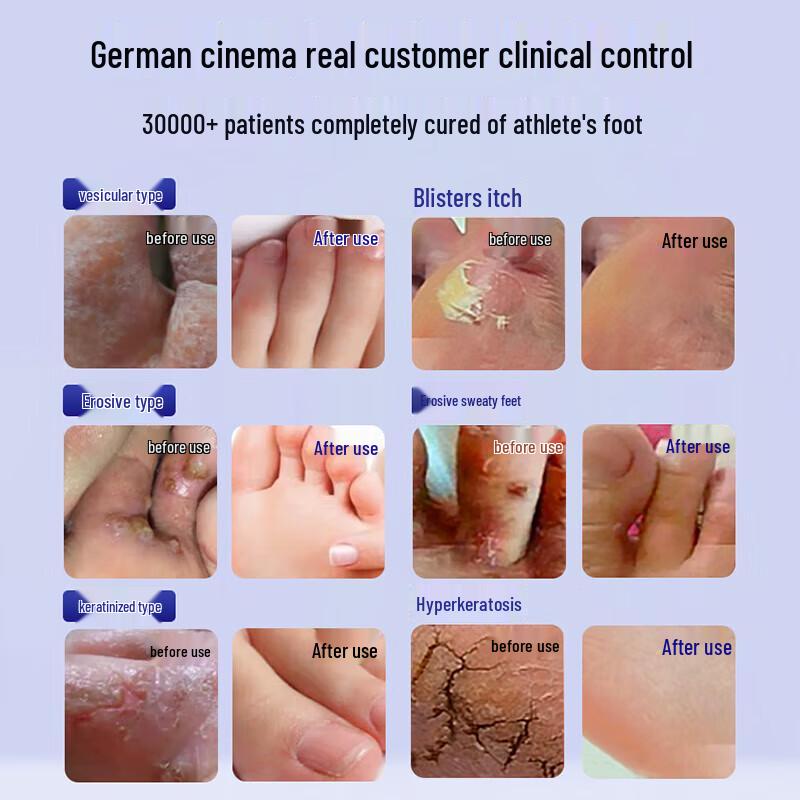 MOIHANR Athlete's Foot Treatment Kit