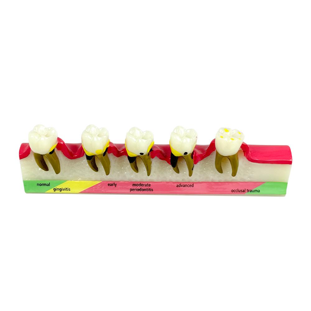 Periodontal Disease Model Dentistry Tooth Model Periodontitis Dental Teeth Model for Studying Teaching Education Demonstration