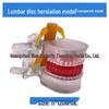 Genuine Lumbar Spine Protrusion & Vertebra Pathology Model