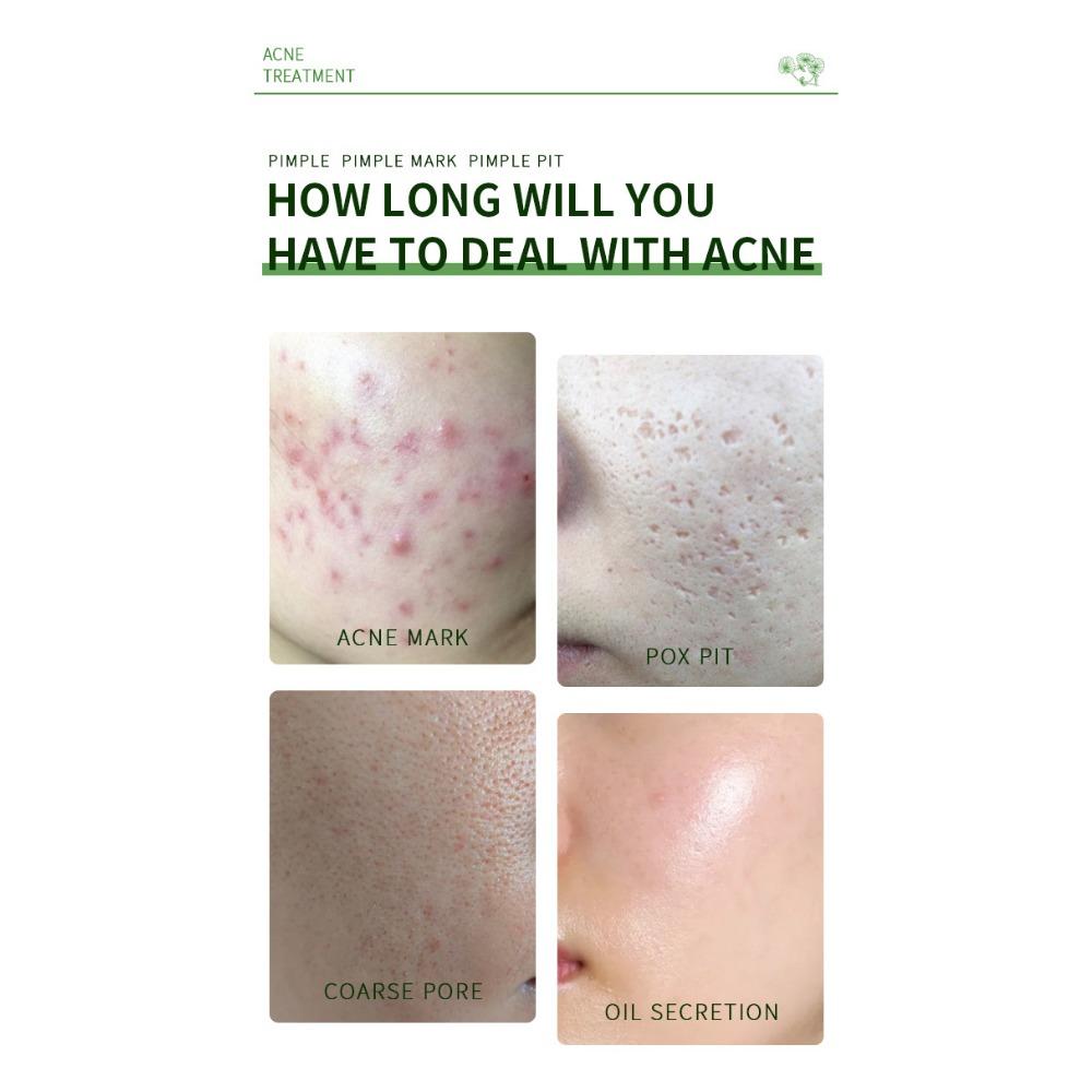 Centella Asiais Acne Cream