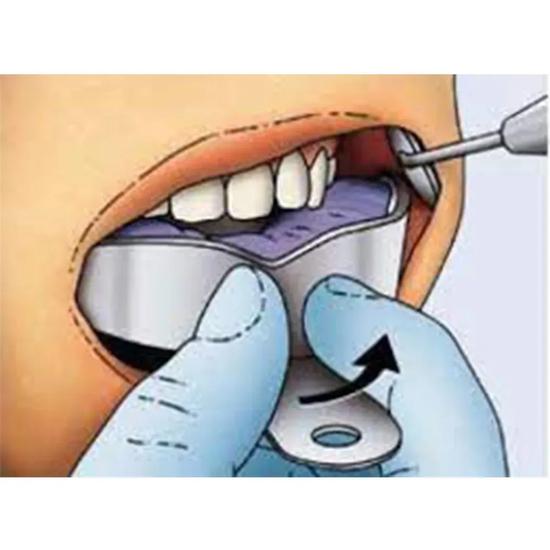 GDC Dentulous Non-Perforated Impression Trays Upper # 1 (Itrldnpu1)