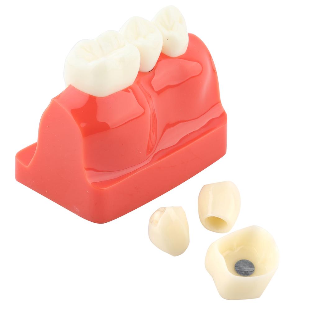 1pc Resin Dental Demonstration Tooth Model Implant Analysis Crown Bridge for Dentist