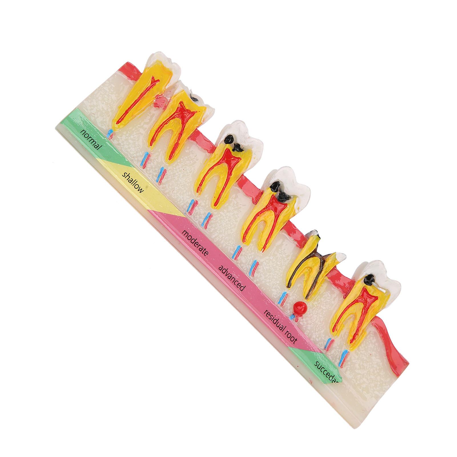 

Модель развития кариеса зубов. Портативная модель пораженных кариесом зубов для обучения стоматологии.