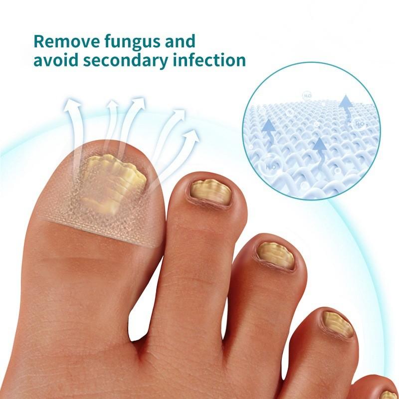 Jaysuing Nährende Nagelreparatur-Pflaster für starke und gesunde Nägel mit Weichgel-Formel