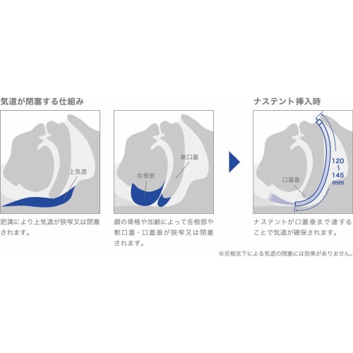 General medical device for preventing snoring: Nastent Classic (Right 145mm Soft)