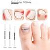 Ingrown Toenail Corrector Tools Pedicure Recover Embed Toe Nail Treatment Professional Ingrown Toenail Straightening Clip Brace
