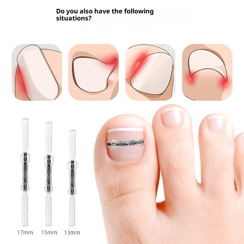 Ingrown Toenail Corrector Tools Pedicure Recover Embed Toe Nail Treatment Professional Ingrown Toenail Straightening Clip Brace