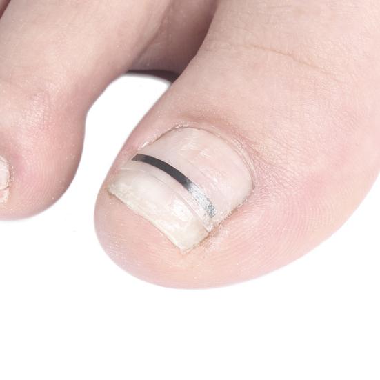 Yousheng Titanium Alloy Ingrown Toenail Corrector Kit for Curved Nail Repair Ingrown Toenail Treatment Tool Toe Nail Straightener