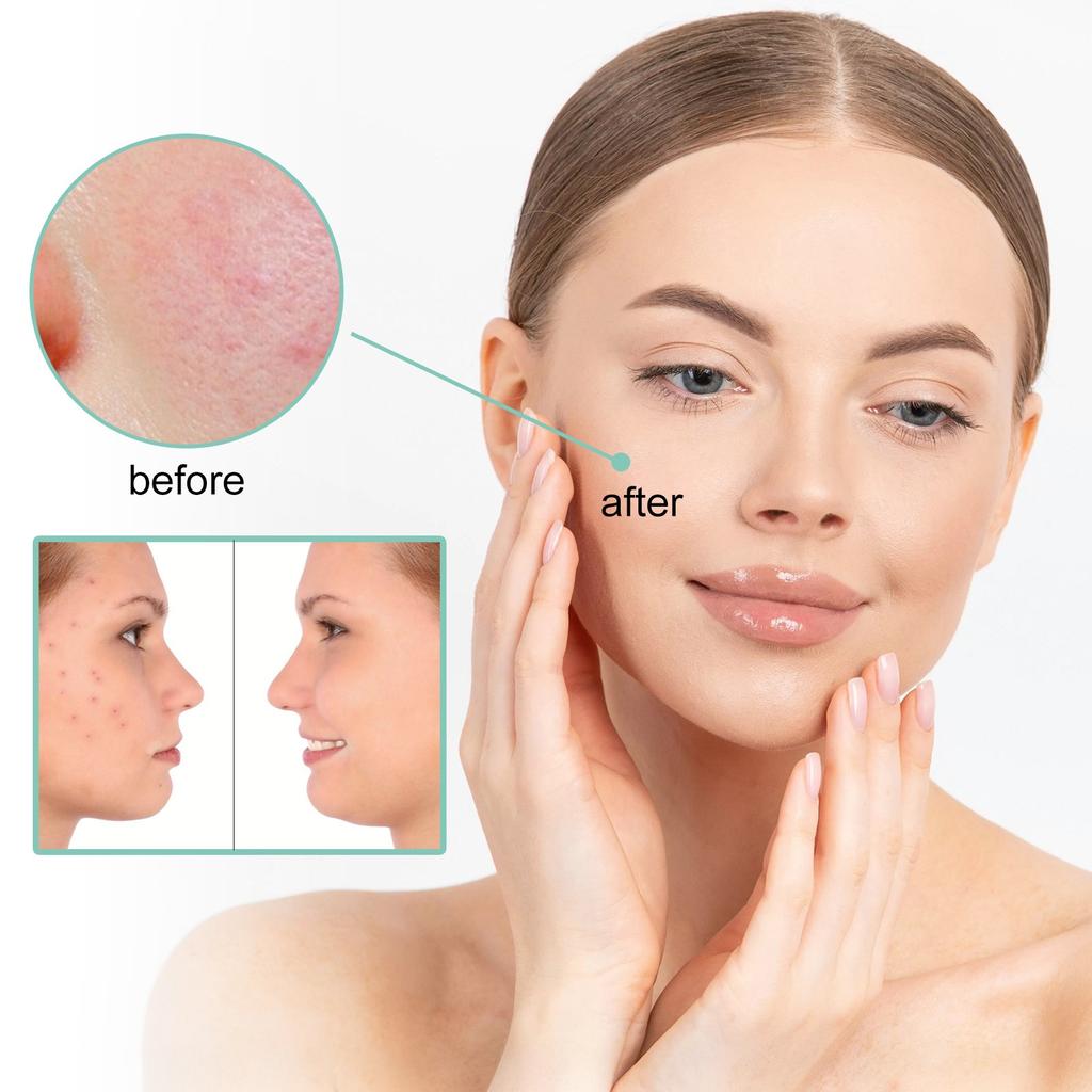 Acne Cream, Facial Cleansing And Acne Cleansing Cream, Gentle Acne Removing And Brightening Facial Skin Care Cream