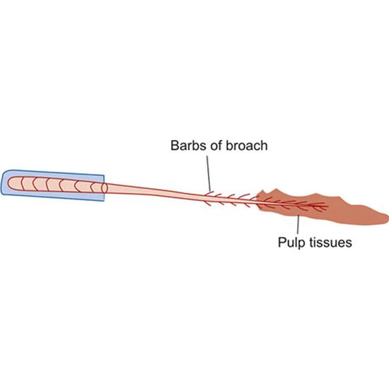 Waldent Short Barbed Broaches