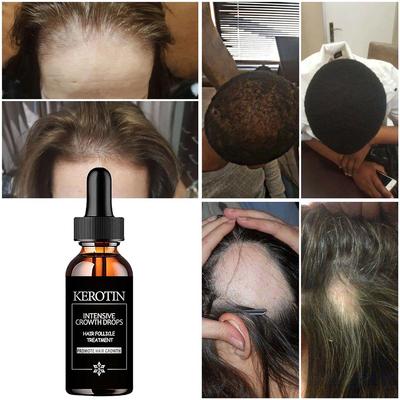 Nouveautés Produits de croissance des cheveux Huile essentielle Soins capillaires Traitement capillaire Sérum de croissance des cheveux Produits de beauté bio anti-chute de cheveux