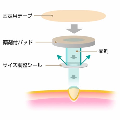 Nichiban Speel Plaster, Corn and Callus Removal, Pinpoint Type, 8 Sheets