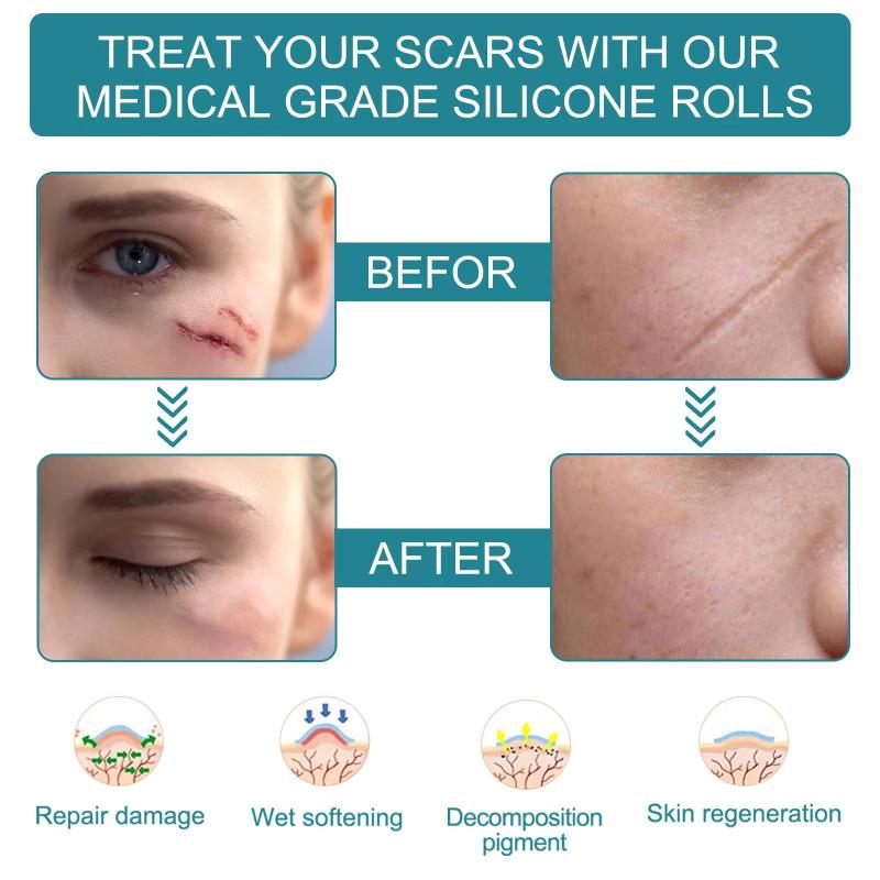 1 Roll Silicone Gel Scar Sheet Patch Treatment Removal Tape Cover Burn Trauma Repair Acne Ear Scar Section Beauty Skin